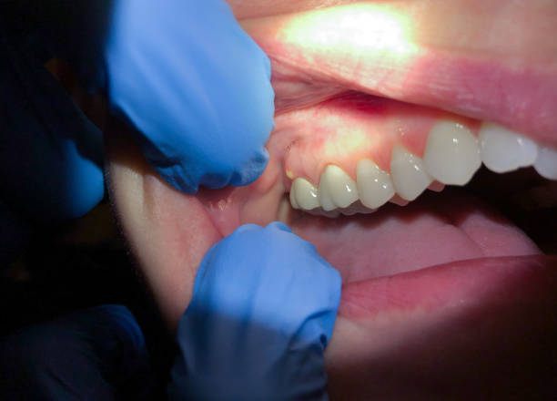 Best Chipped Tooth Repair Near Me  in Dulles Town Center, VA